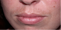 melasma3