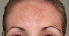 melasma4