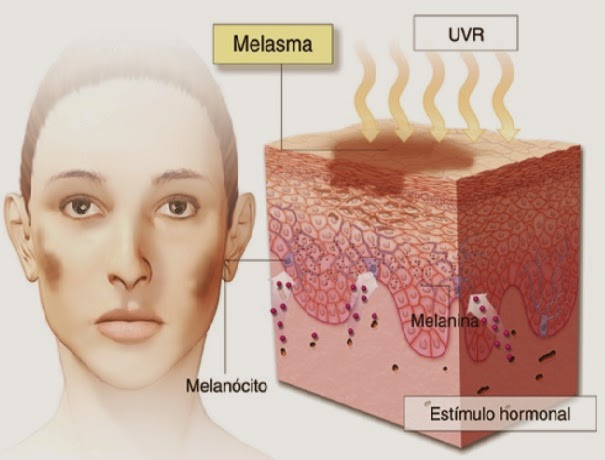 Tratamentos caseiros para acabar com o melasma